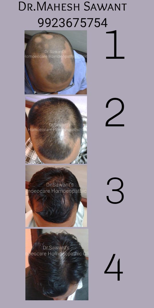 Alopecia treatment progress timeline