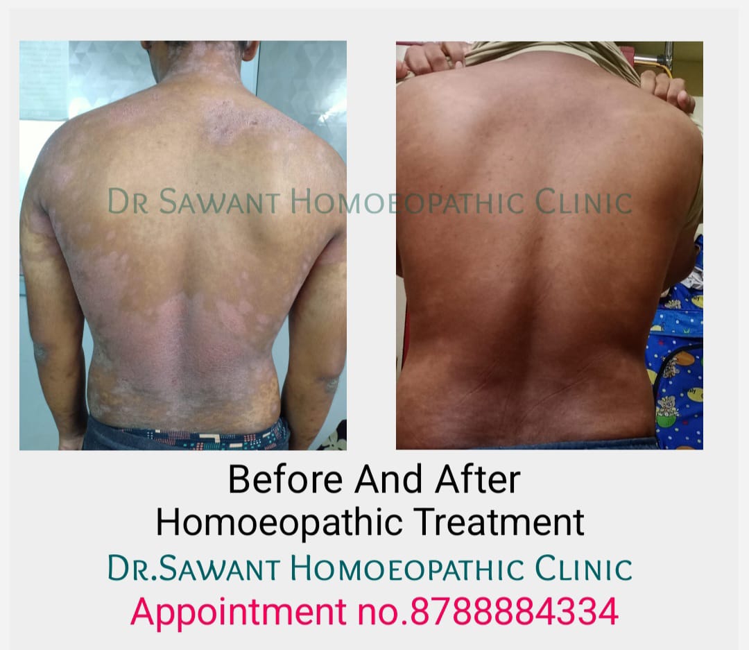 Back psoriasis before and after progress