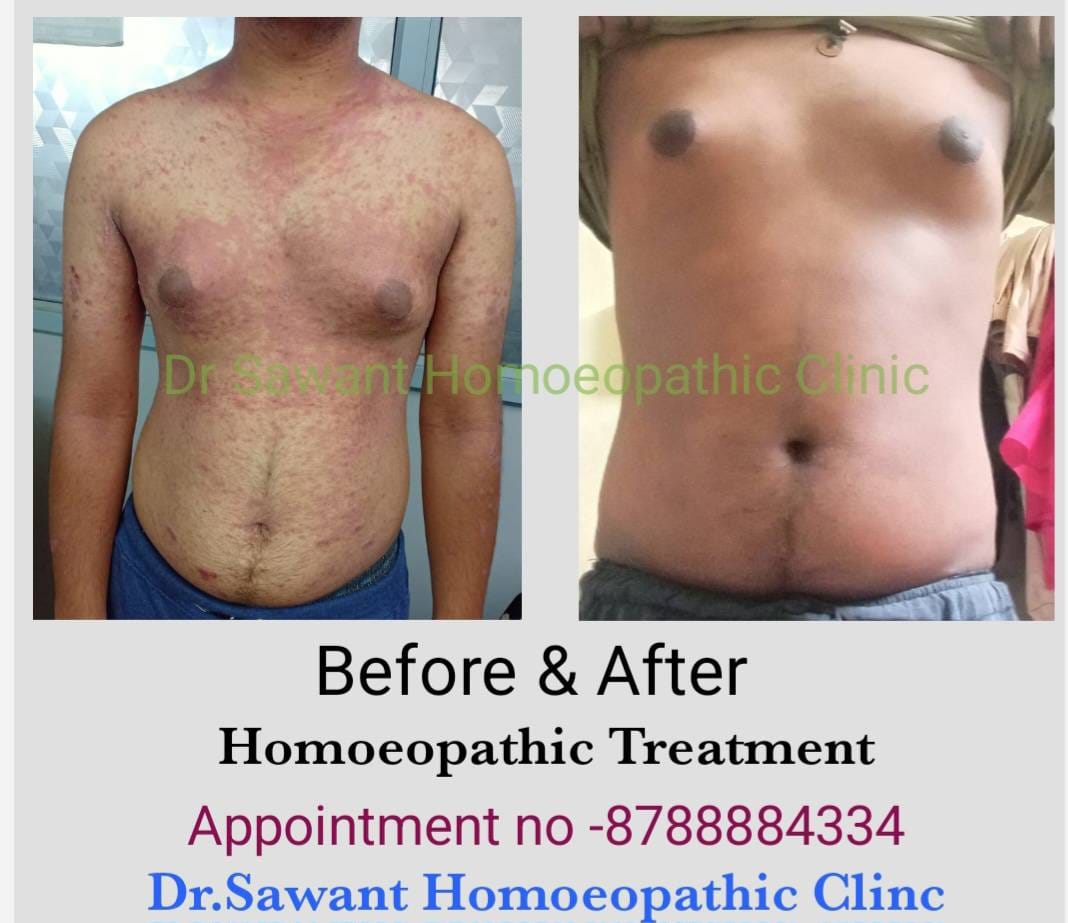 Body psoriasis before and after progress