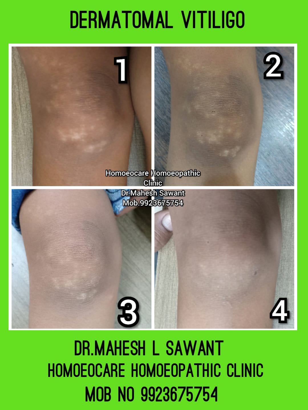 Dermatomal vitiligo progress timeline