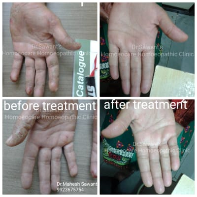 Hand eczema before and after progress