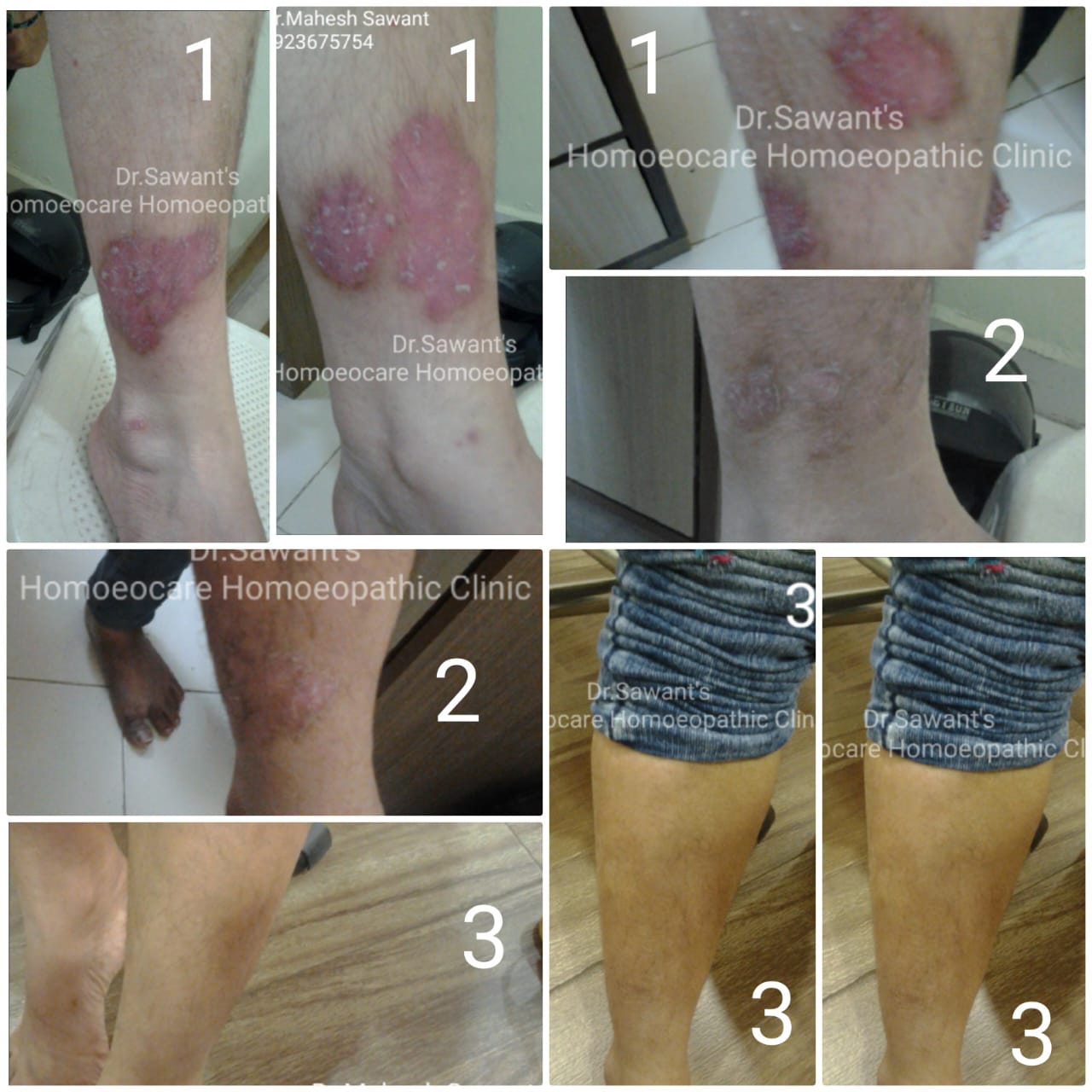 Leg lesions treatment progress