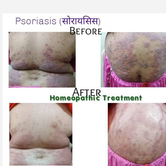 Psoriasis progress grid