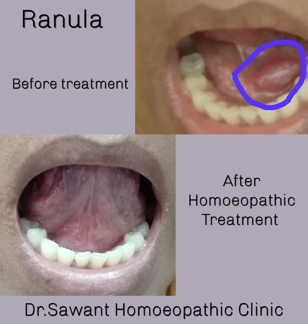 Ranula before and after progress